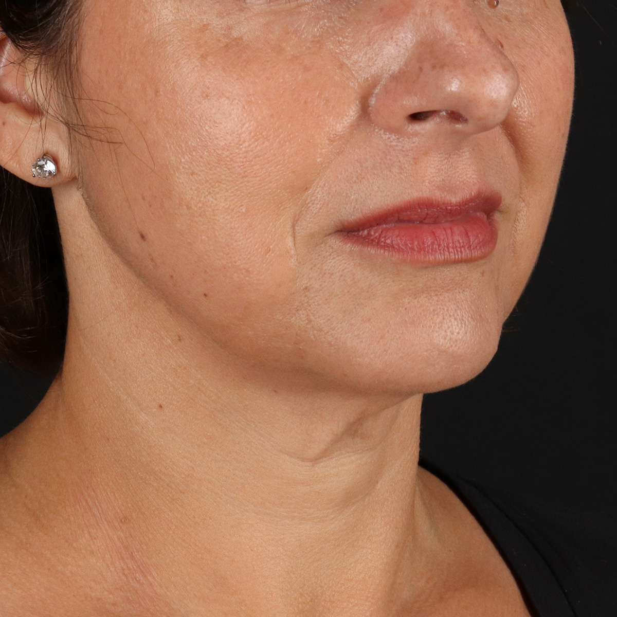 Neck Lift Before & After Patient #2472