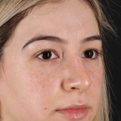 Rhinoplasty Before & After Patient #3247