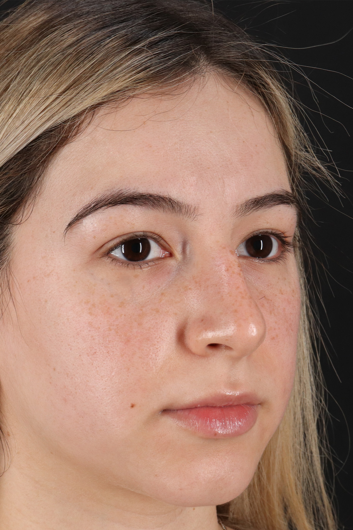 Rhinoplasty Before & After Patient #3247