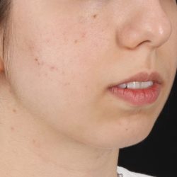 Chin Implant Before & After Patient #1551