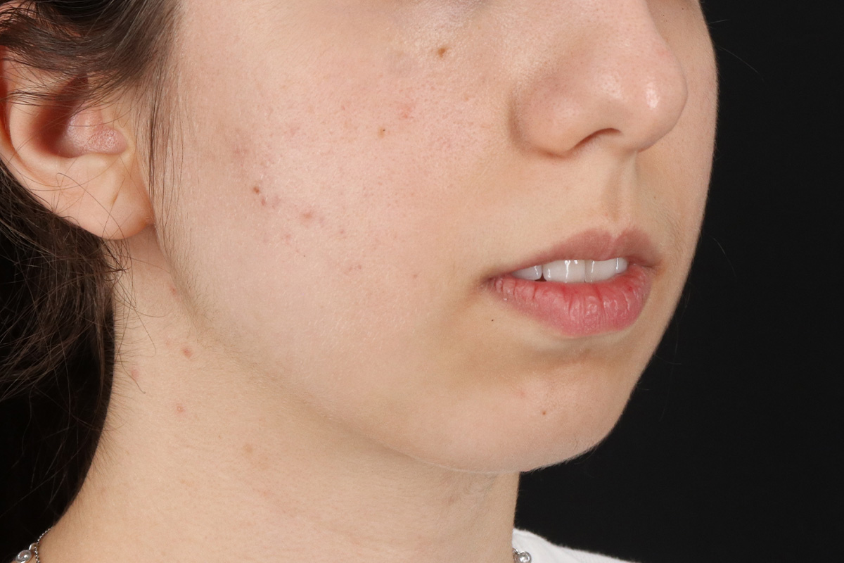 Chin Implant Before & After Patient #1551