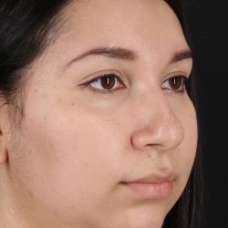 Chin Implant Before & After Patient #1604