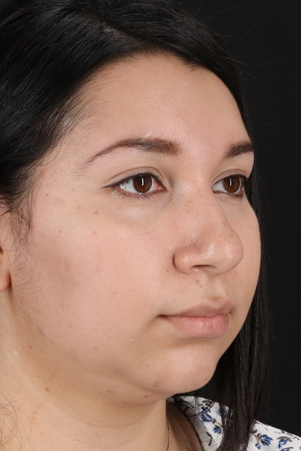 Chin Implant Before & After Patient #1604