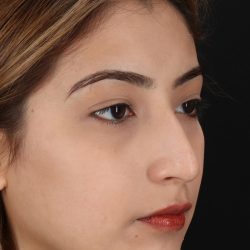 Liquid Rhinoplasty Before & After Patient #2254