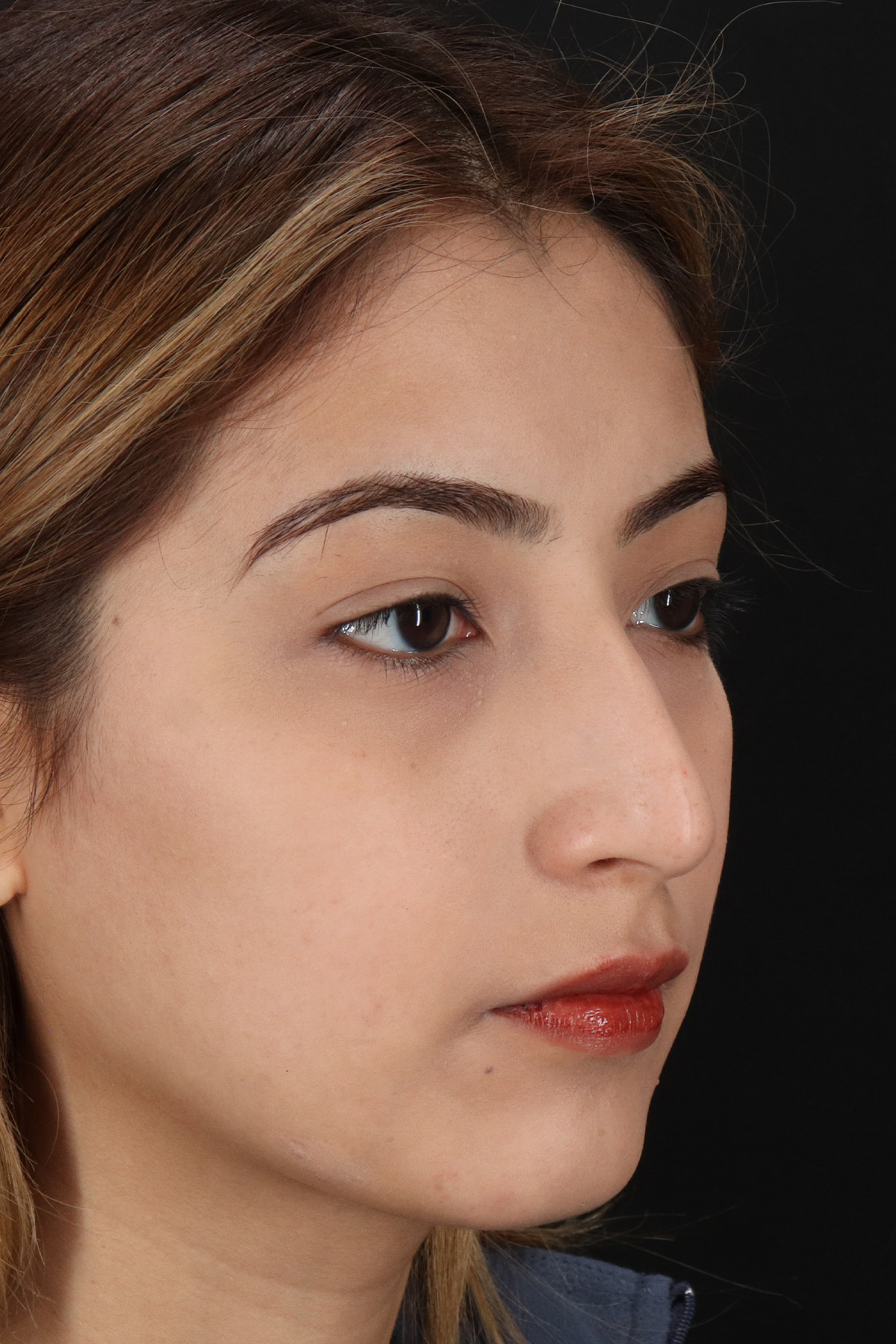 Liquid Rhinoplasty Before & After Patient #2254