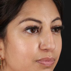 Rhinoplasty Before & After Patient #3049