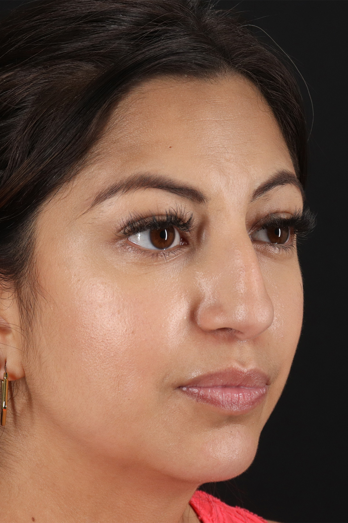 Rhinoplasty Before & After Patient #3049