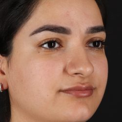 Rhinoplasty Before & After Patient #3071