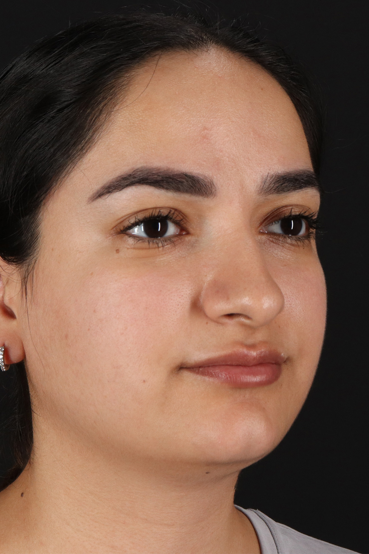 Rhinoplasty Before & After Patient #3071