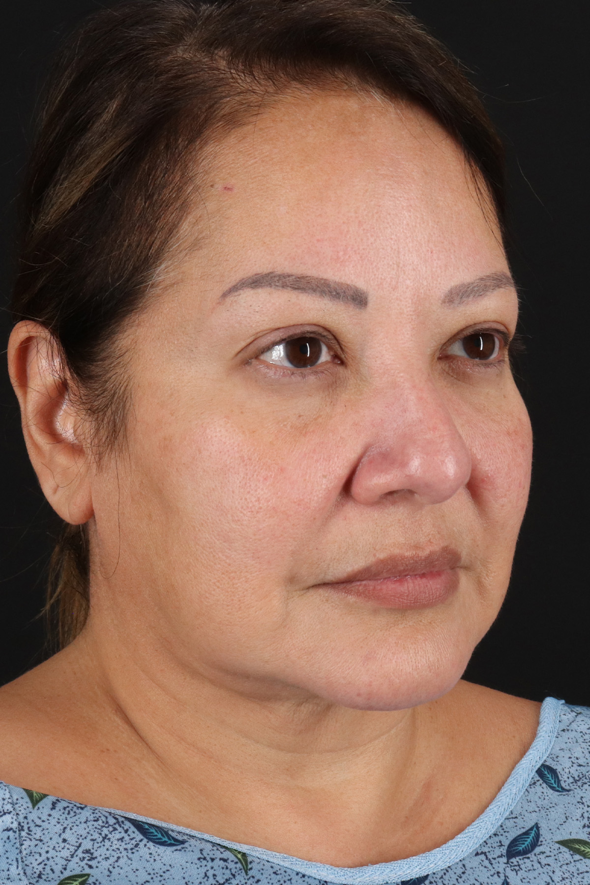 Neck Lift Before & After Patient #2593