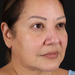 Facelift Before & After Patient #1888