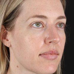 Rhinoplasty Before & After Patient #3291