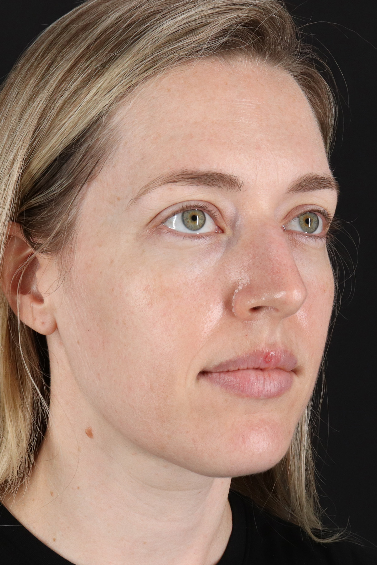 Rhinoplasty Before & After Patient #3291