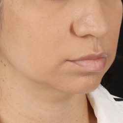 Chin Implant Before & After Patient #1540