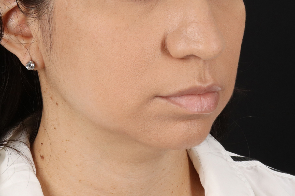 Chin Implant Before & After Patient #1540