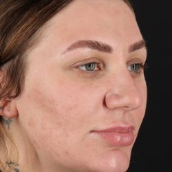 Rhinoplasty Before & After Patient #3104