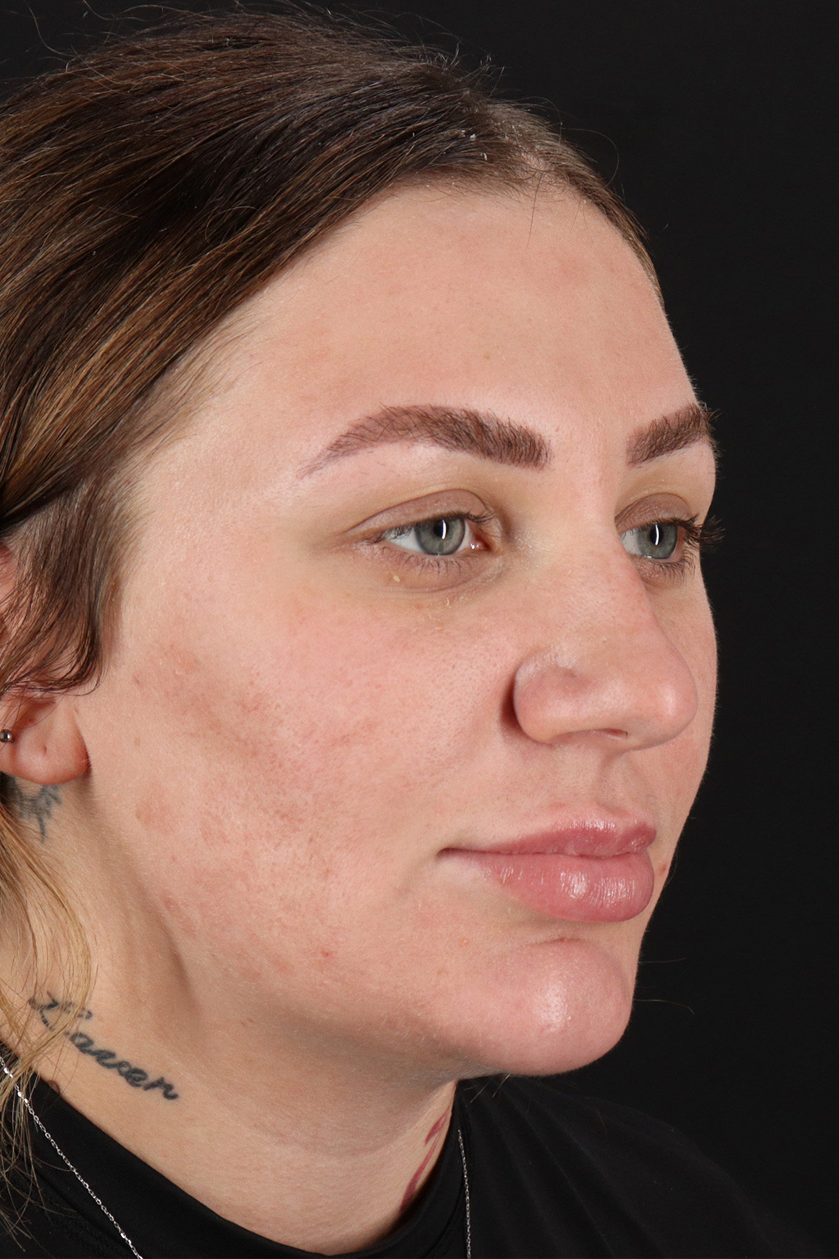 Rhinoplasty Before & After Patient #3104