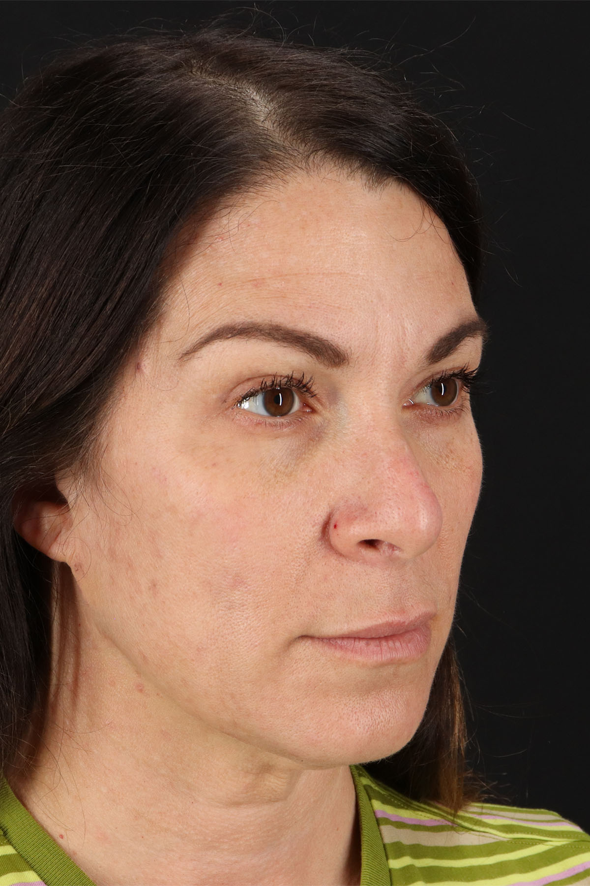 Lip Lift Before & After Patient #2133