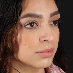 Rhinoplasty Before & After Patient #3269