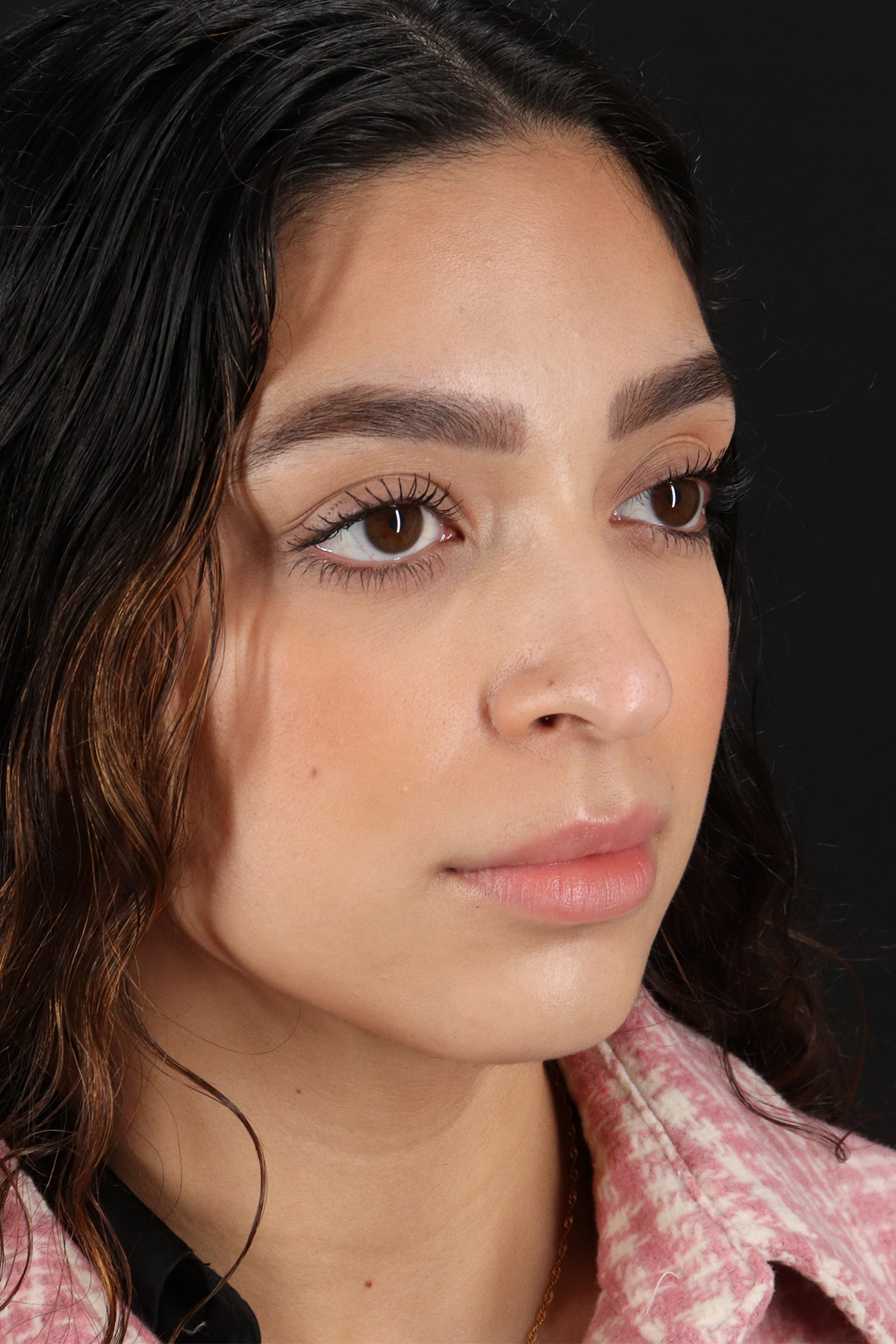 Rhinoplasty Before & After Patient #3269