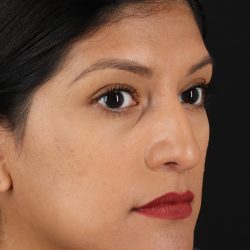 Rhinoplasty Before & After Patient #3181