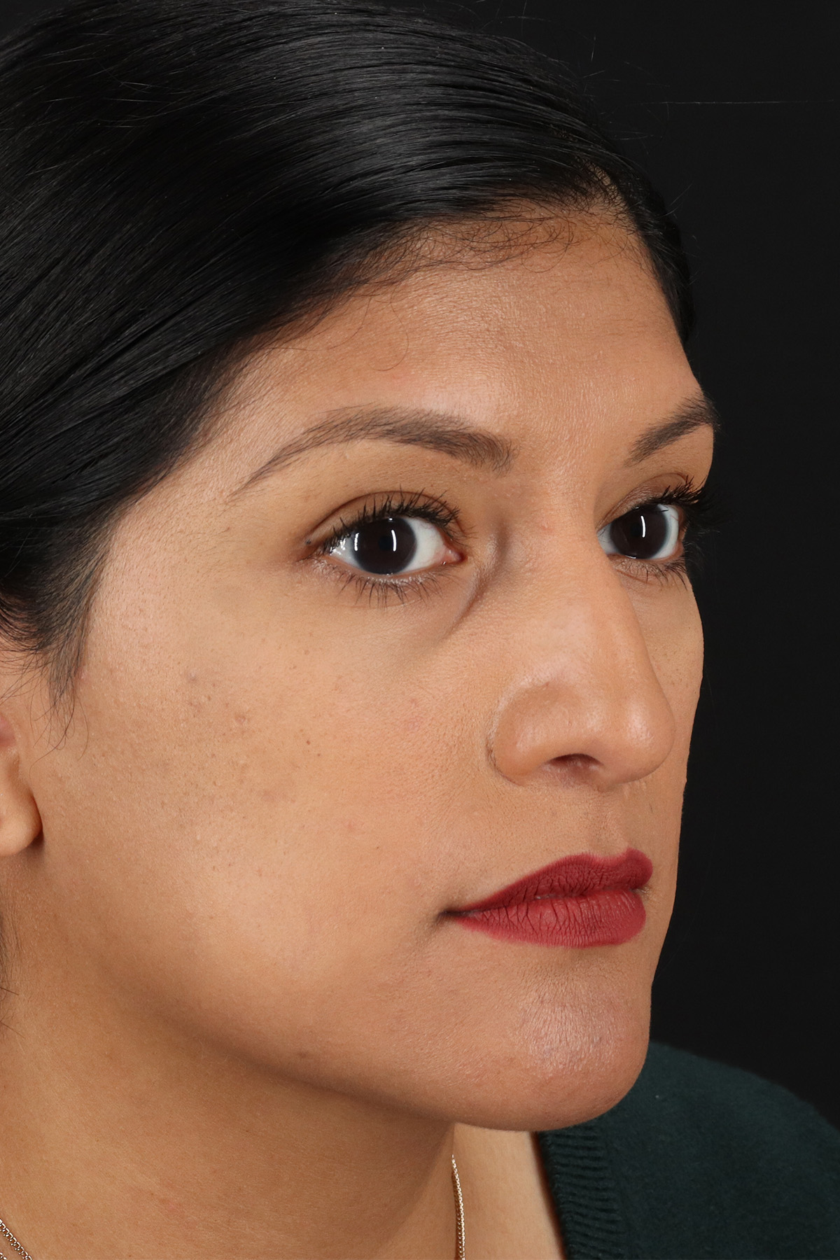 Rhinoplasty Before & After Patient #3181