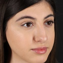 Rhinoplasty Before & After Patient #3214