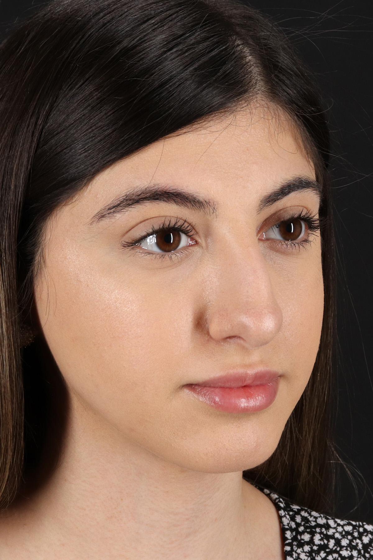 Rhinoplasty Before & After Patient #3214