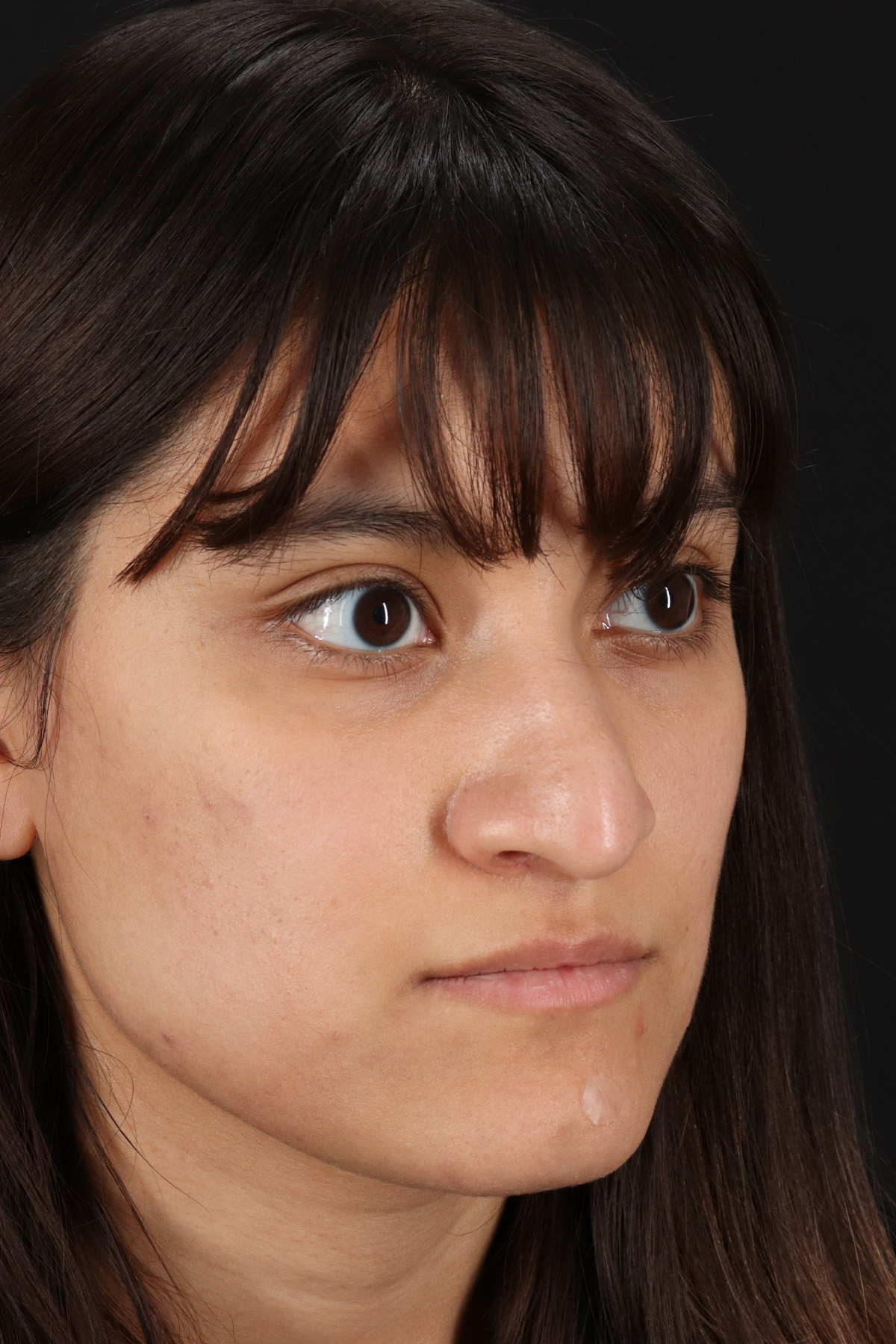 Rhinoplasty Before & After Patient #3038