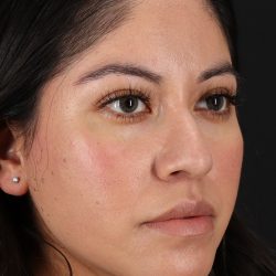 Fillers Before & After Patient #2063