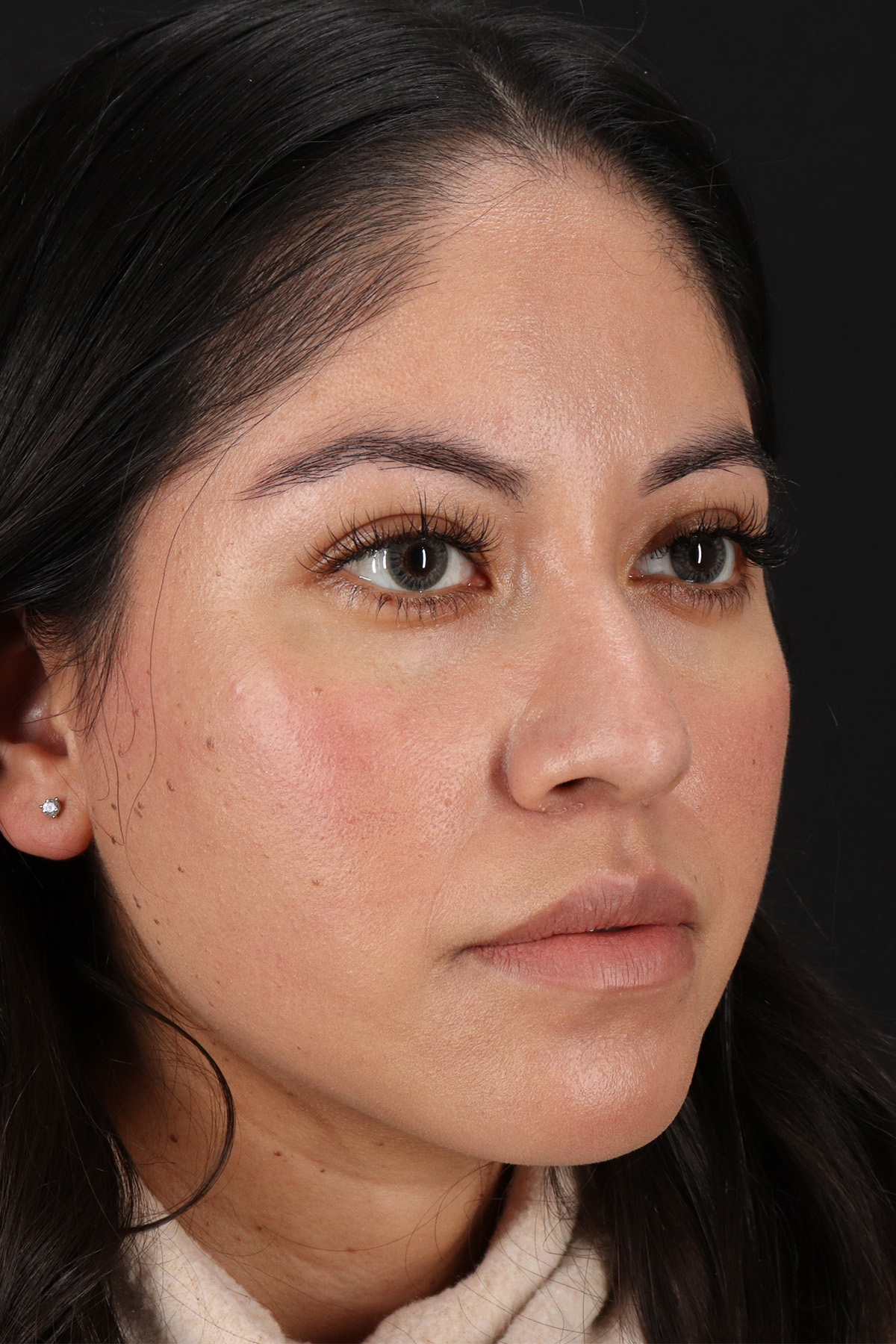 Liquid Rhinoplasty Before & After Patient #2290