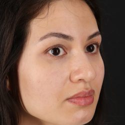 Rhinoplasty Before & After Patient #3236