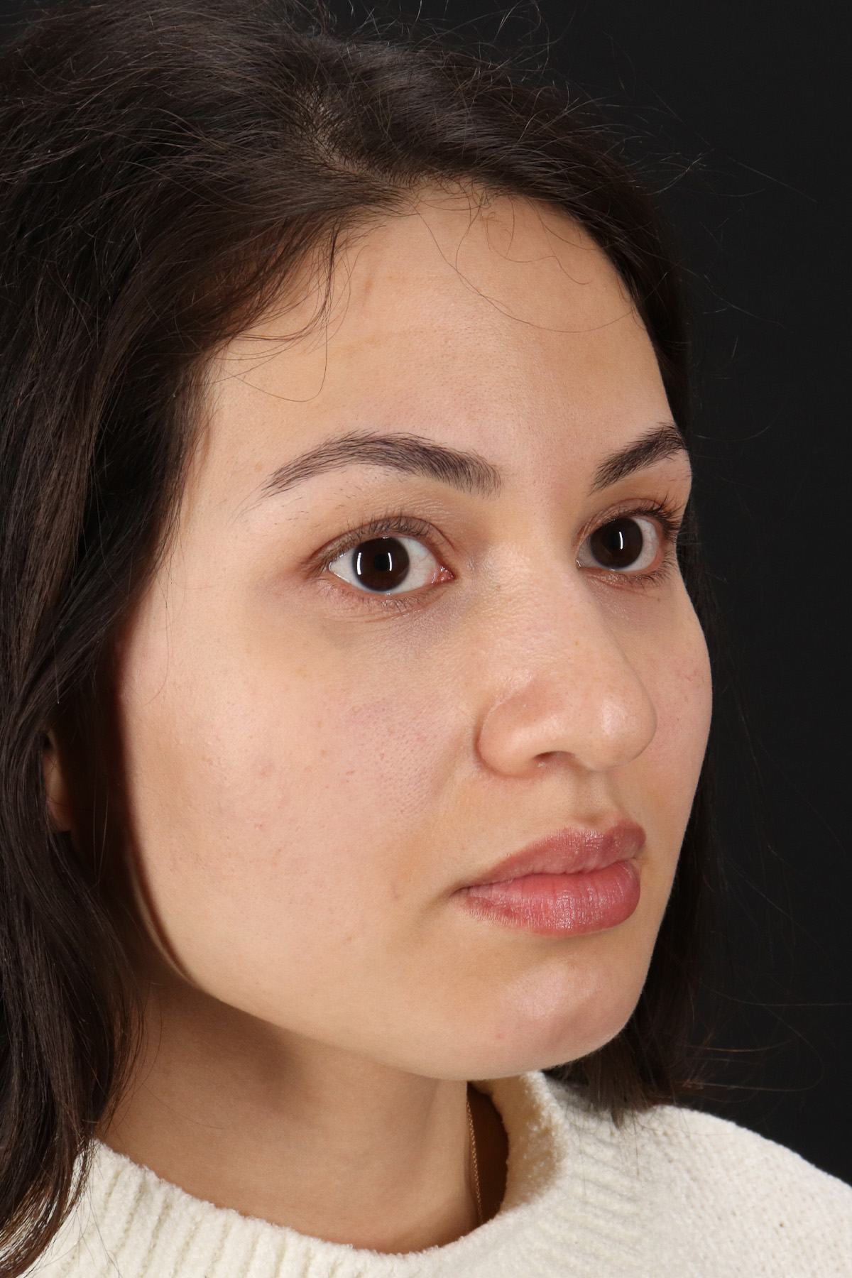 Rhinoplasty Before & After Patient #3236
