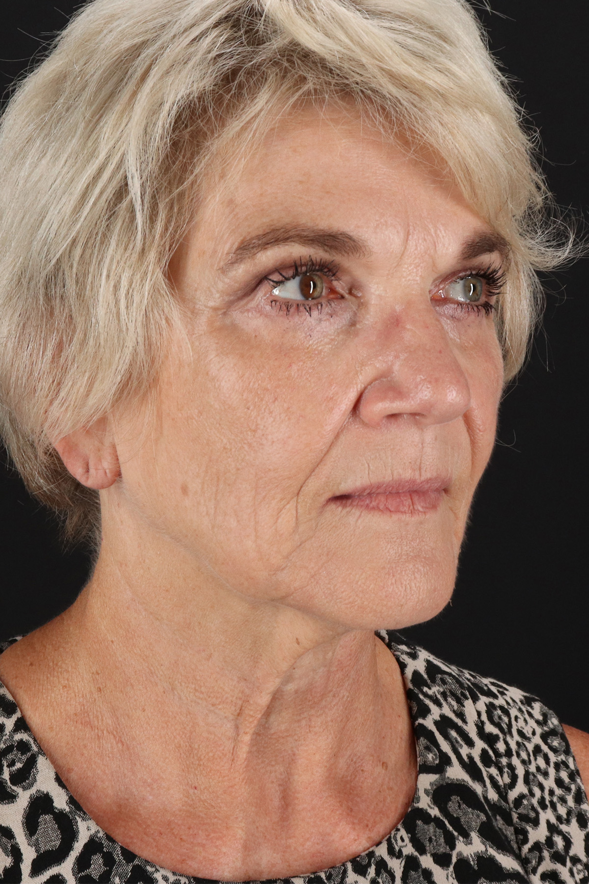 Neck Lift Before & After Patient #2648