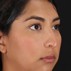 Liquid Rhinoplasty Before & After Patient #2232