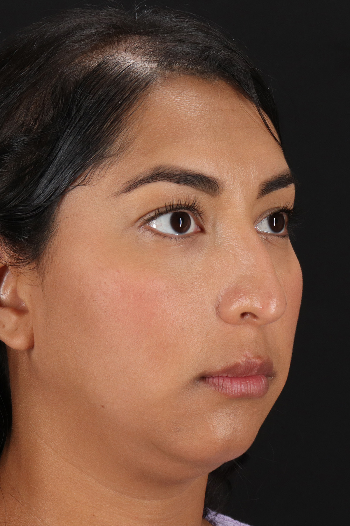 Liquid Rhinoplasty Before & After Patient #2232