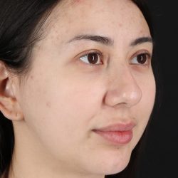 Rhinoplasty Before & After Patient #3159