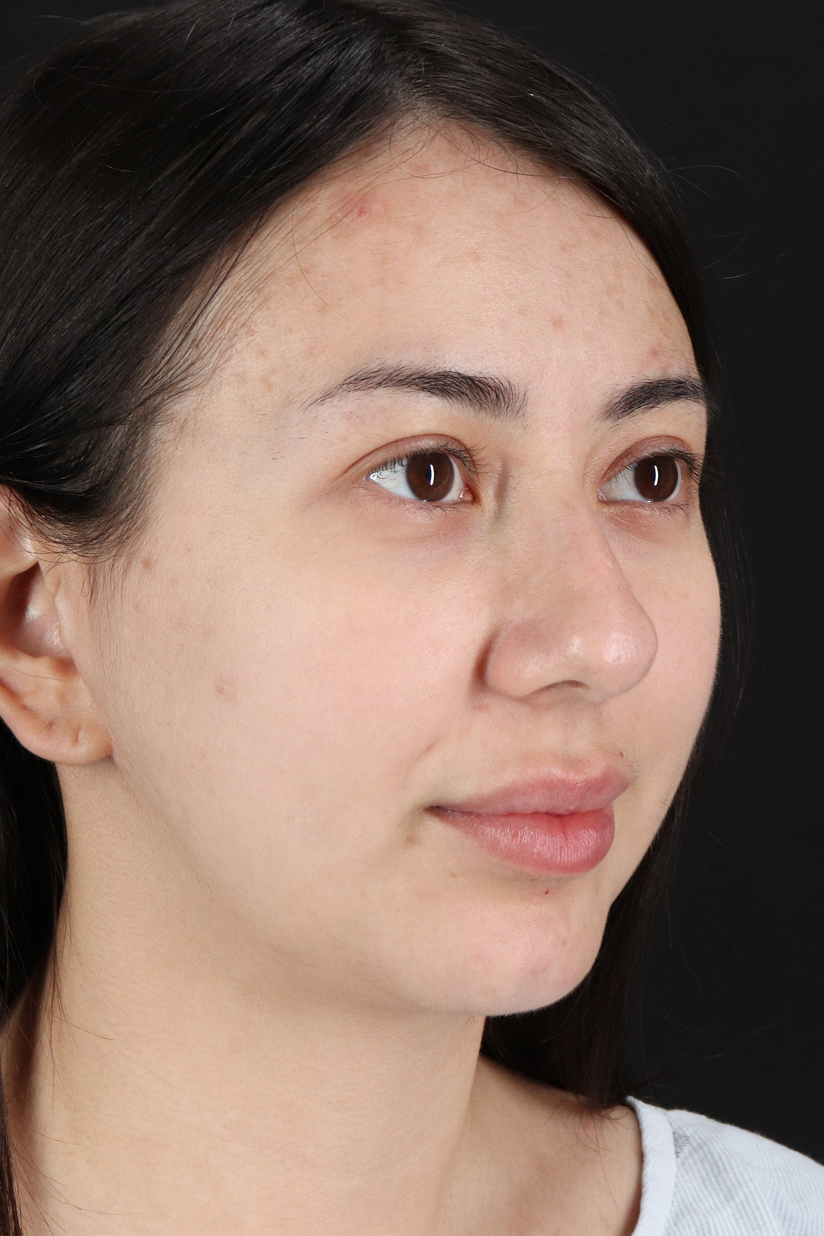 Rhinoplasty Before & After Patient #3159