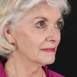 Upper Blepharoplasty Before & After Patient #5377