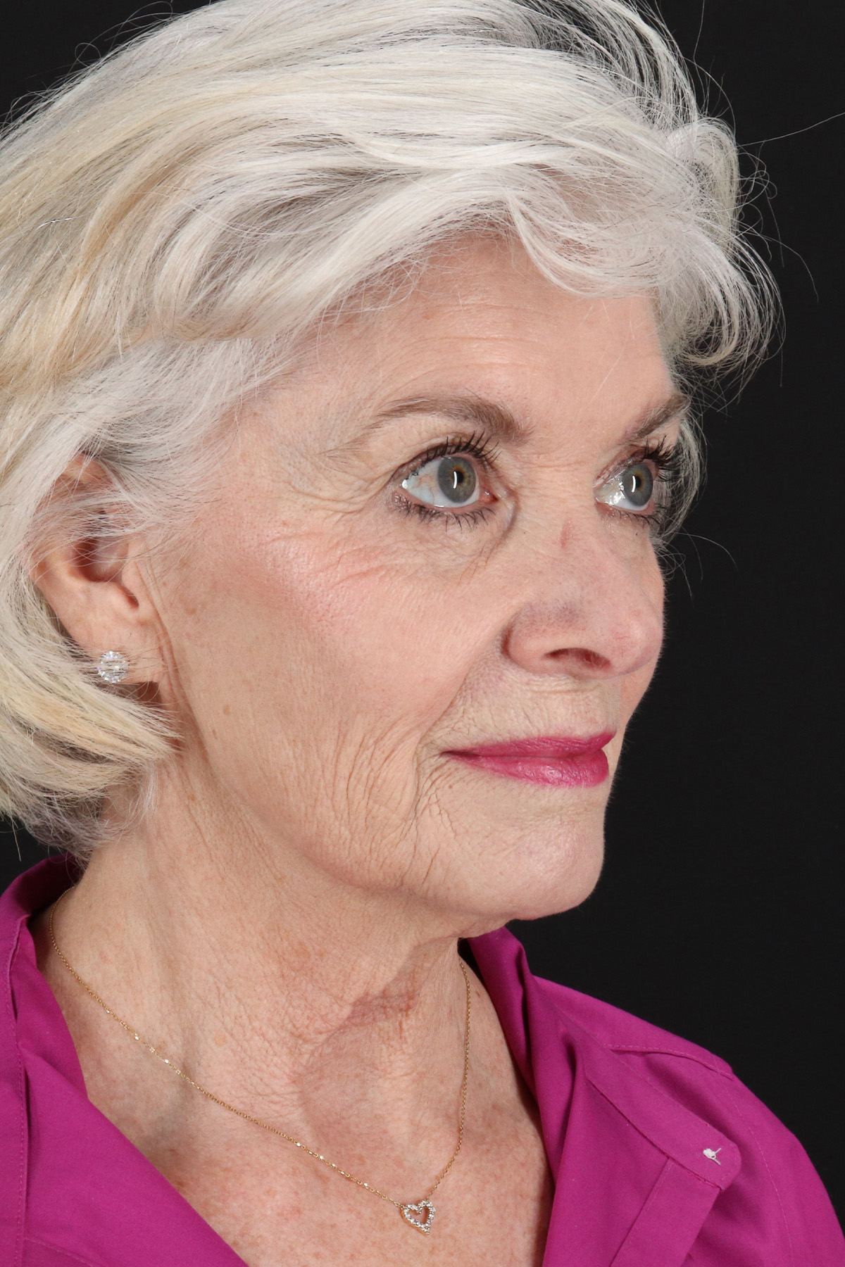 Upper Blepharoplasty Before & After Patient #5377
