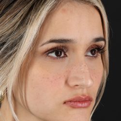 Rhinoplasty Before & After Patient #3258
