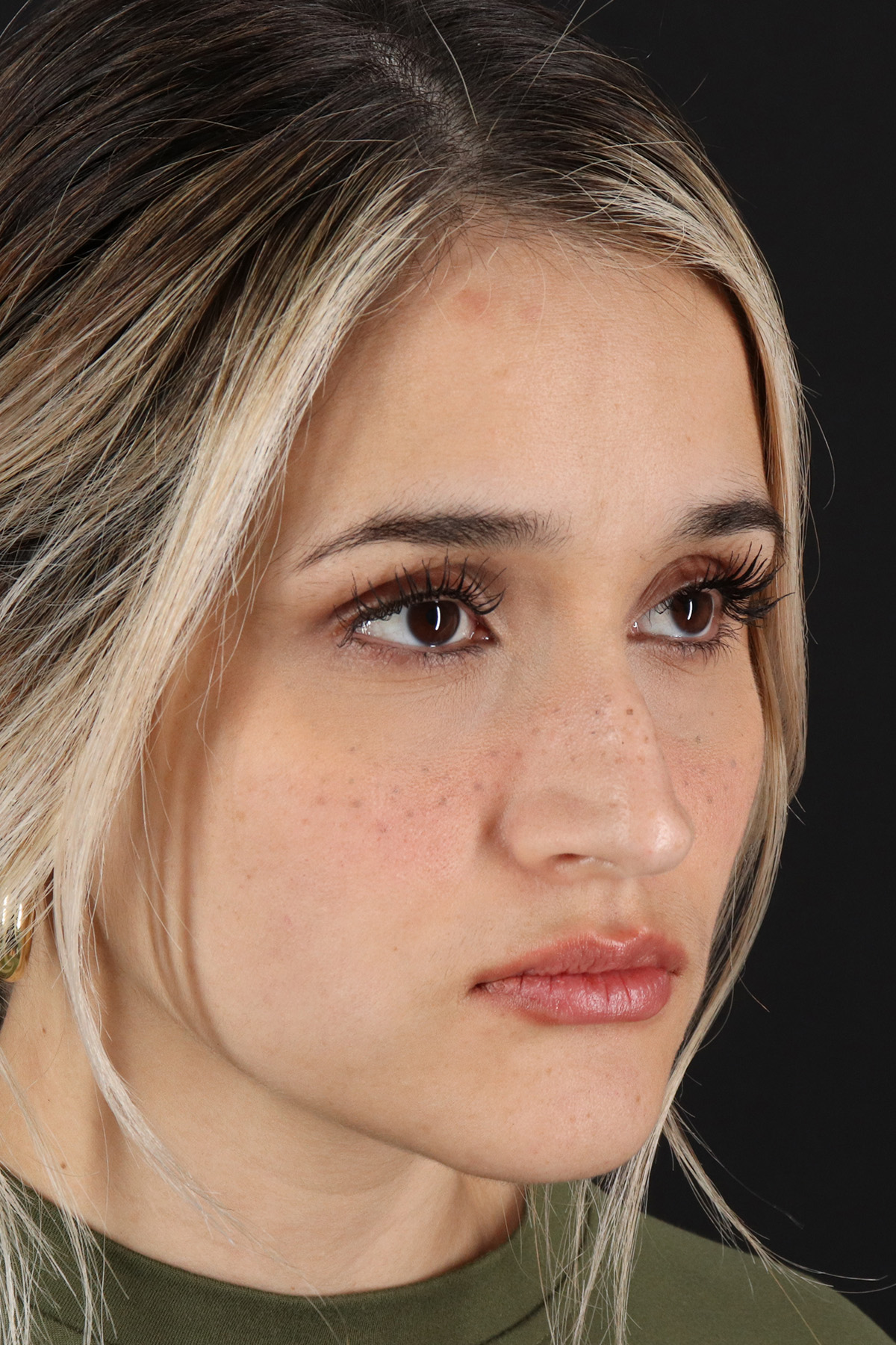 Rhinoplasty Before & After Patient #3258