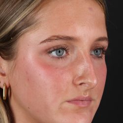 Liquid Rhinoplasty Before & After Patient #2221