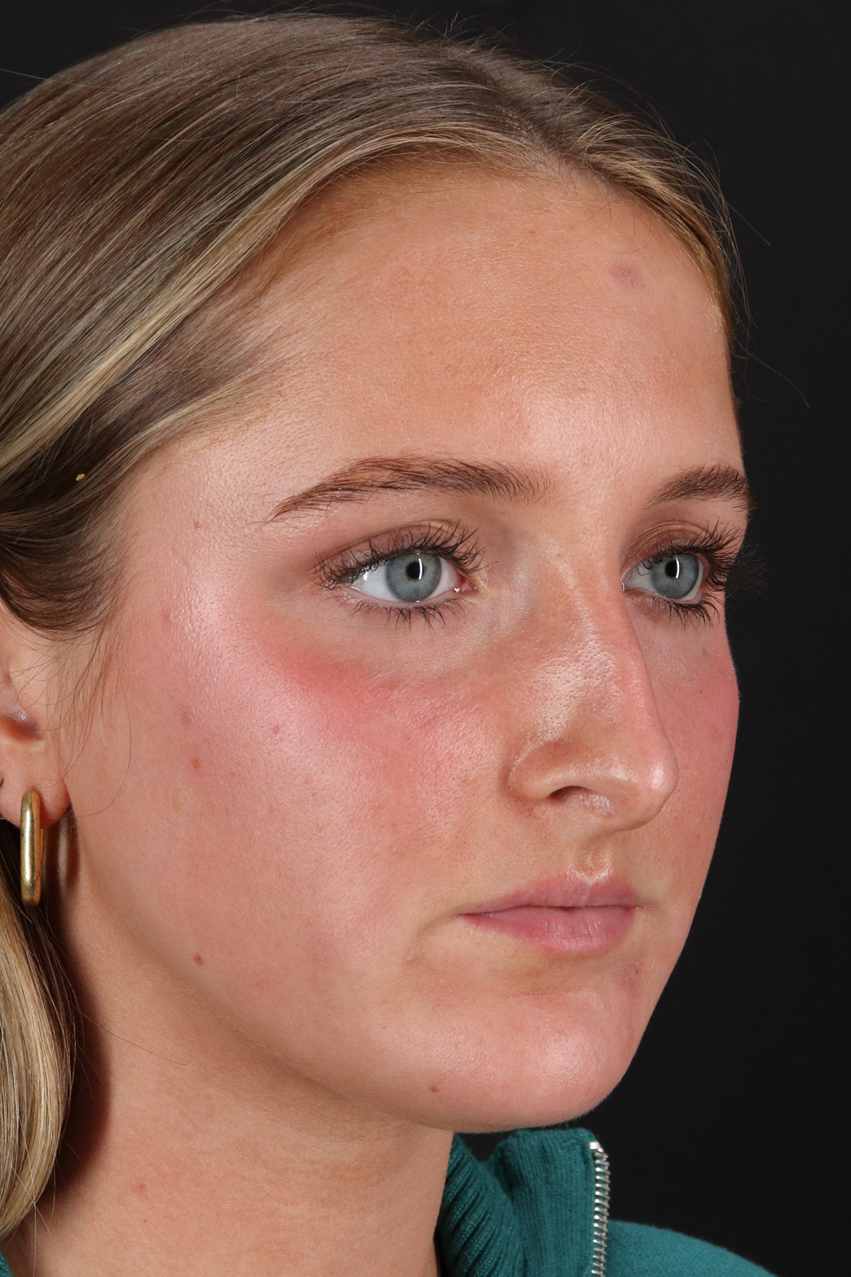 Liquid Rhinoplasty Before & After Patient #2221