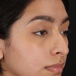 Chin Implant Before & After Patient #1637