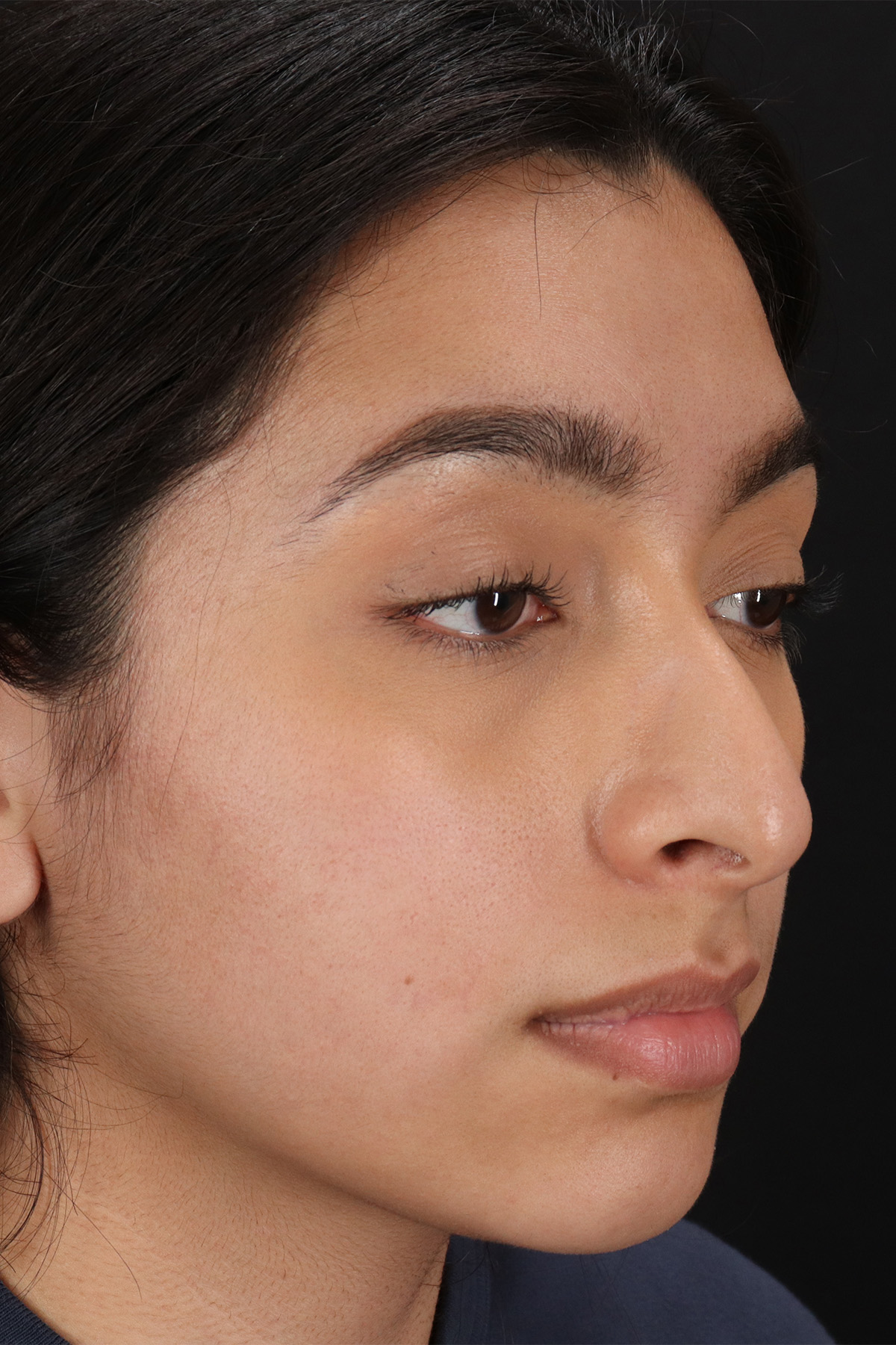 Chin Implant Before & After Patient #1637