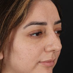 Rhinoplasty Before & After Patient #3115