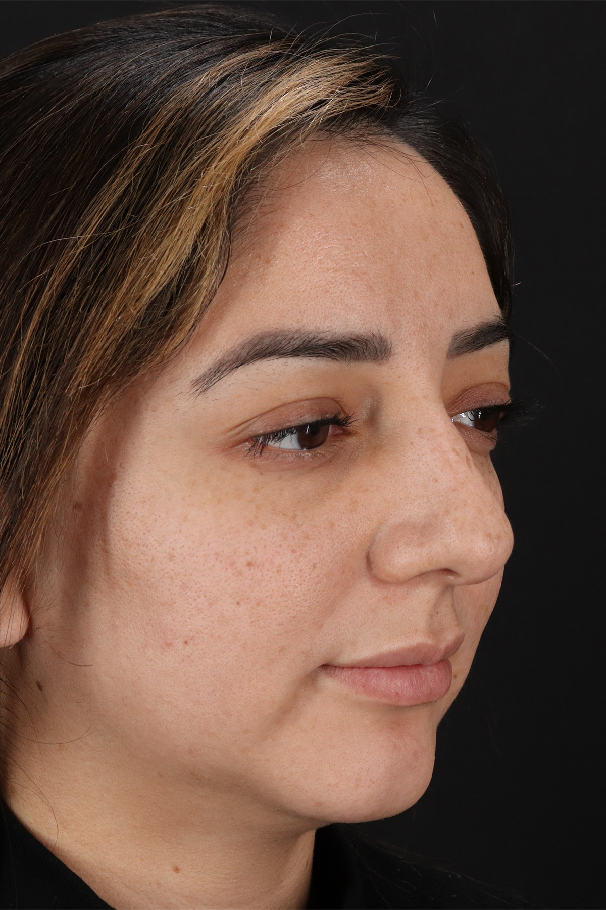 Rhinoplasty Before & After Patient #3115