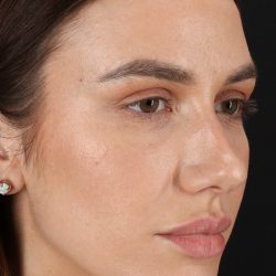 Rhinoplasty Before & After Patient #3137