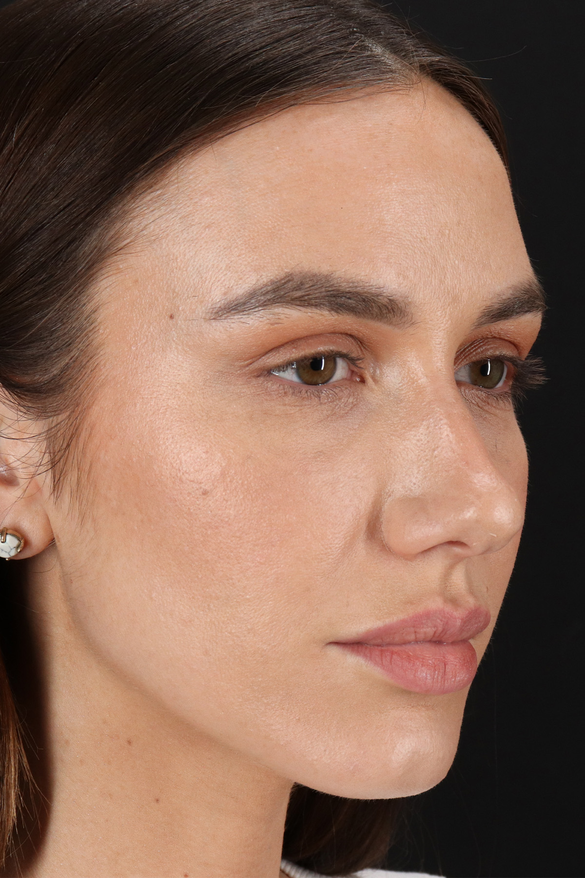 Rhinoplasty Before & After Patient #3137